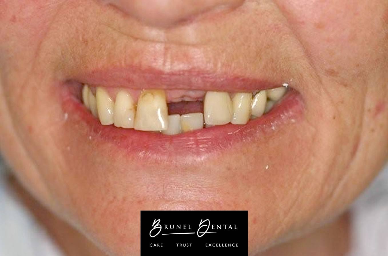 brunel dental before image