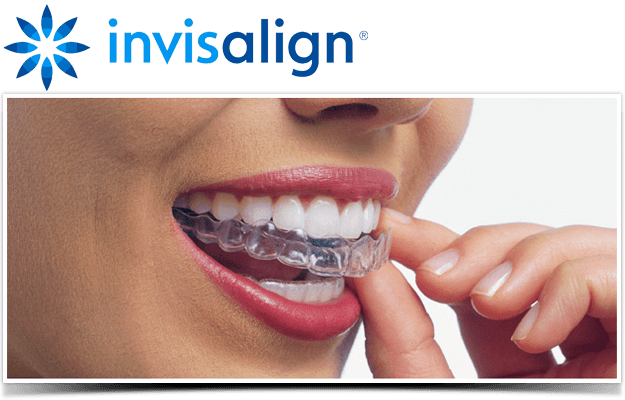 Invisalign