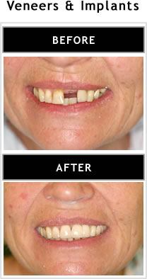 veneers and implants before and after