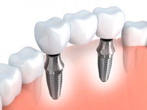 good option an implant-supported bridge