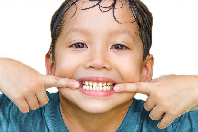 too much fluoride can cause white spots on teeth