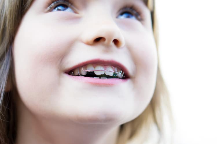 when should my child have braces