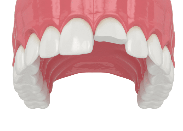 what can you do about chipped tooth