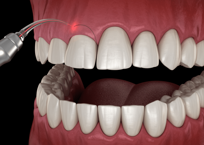 what is laser dentistry