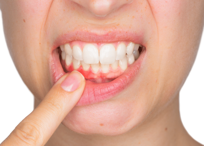what can be done about receding gums