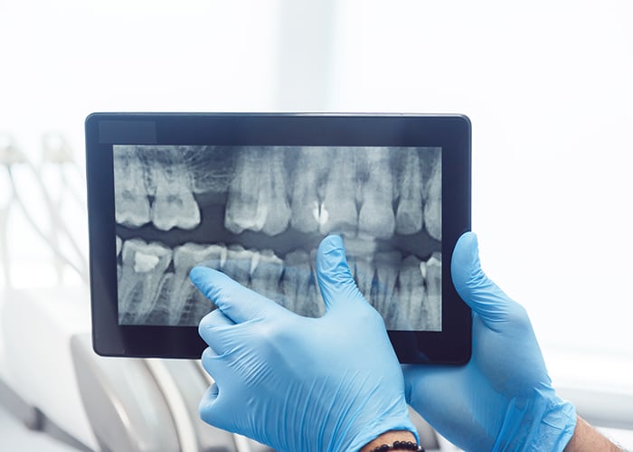 why x-rays are an important part of a dental check-up