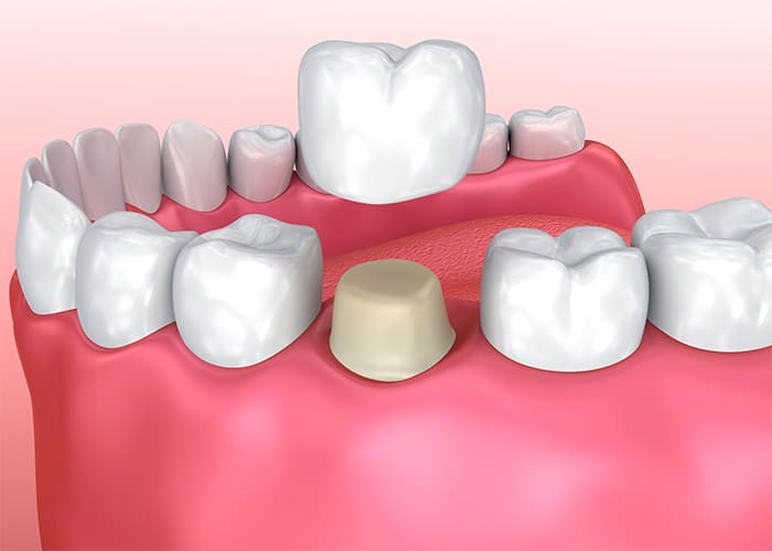 are dental crowns necessary