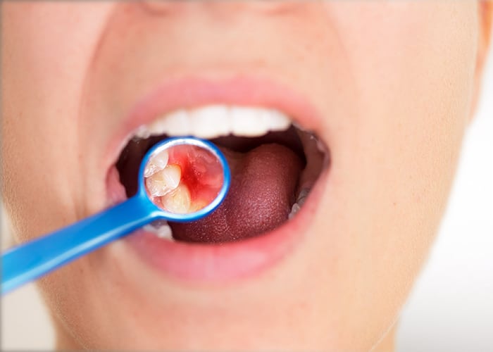 gum disease at home