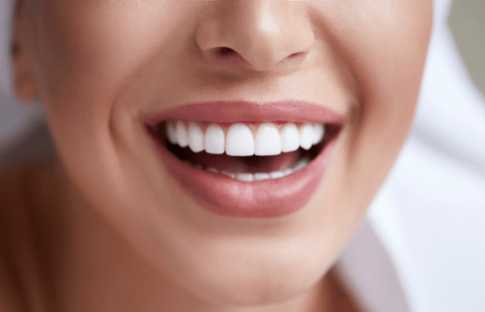 woman smiling wearing clear Invisalign aligners